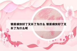 銀屑病快好了又長了為什么 銀屑病快好了又長了為什么呢