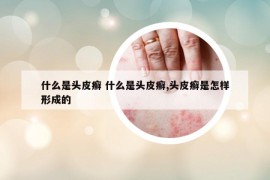 什么是頭皮癬 什么是頭皮癬,頭皮癬是怎樣形成的