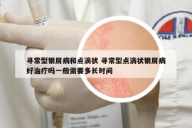尋常型銀屑病和點(diǎn)滴狀 尋常型點(diǎn)滴狀銀屑病好治療嗎一般需要多長(zhǎng)時(shí)間