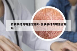 皮膚病打青霉素管用嗎 皮膚病打青霉素管用嗎