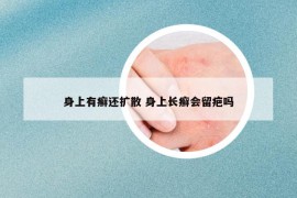 身上有癬還擴(kuò)散 身上長癬會留疤嗎