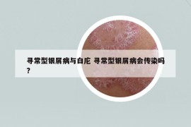 尋常型銀屑病與白庀 尋常型銀屑病會傳染嗎?