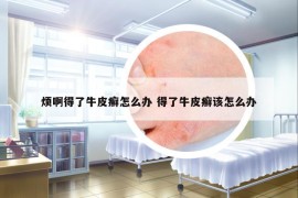 煩啊得了牛皮癬怎么辦 得了牛皮癬該怎么辦
