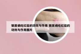 銀屑病吃紅菇的功效與作用 銀屑病吃紅菇的功效與作用圖片
