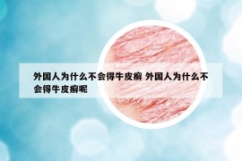 外國人為什么不會得牛皮癬 外國人為什么不會得牛皮癬呢