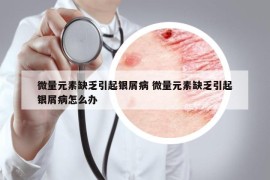 微量元素缺乏引起銀屑病 微量元素缺乏引起銀屑病怎么辦