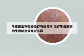 牛皮癬生物磁絡(luò)治療有效果嗎 治療牛皮膚癬的生物制劑效果怎么樣
