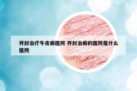 開封治療牛皮癬醫(yī)院 開封治癬的醫(yī)院是什么醫(yī)院