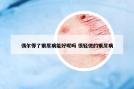 偶爾得了銀屑病能好呢嗎 很輕微的銀屑病