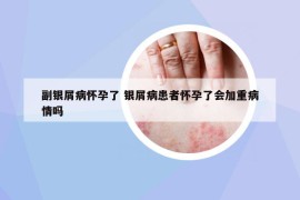 副銀屑病懷孕了 銀屑病患者懷孕了會加重病情嗎