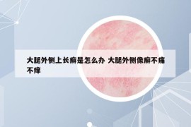 大腿外側(cè)上長(zhǎng)癬是怎么辦 大腿外側(cè)像癬不痛不癢