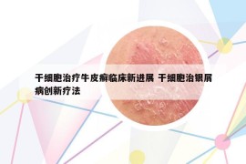 干細(xì)胞治療牛皮癬臨床新進(jìn)展 干細(xì)胞治銀屑病創(chuàng)新療法