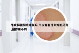 牛皮鮮能徹底康復嗎 牛皮鮮有什么好的藥膏,副作用小的