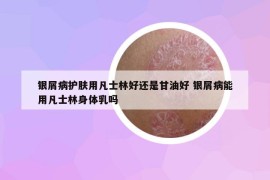 銀屑病護(hù)膚用凡士林好還是甘油好 銀屑病能用凡士林身體乳嗎