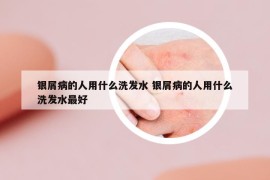 銀屑病的人用什么洗發(fā)水 銀屑病的人用什么洗發(fā)水最好