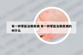 有一種草能治銀屑病 有一種草能治銀屑病的叫什么