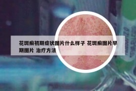 花斑癬初期癥狀圖片什么樣子 花斑癬圖片早期圖片 治療方法