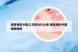 銀屑病在中醫(yī)上又稱為什么病 銀屑病的中醫(yī)病因病機(jī)