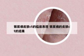 銀屑病皮膚ct的臨床表現(xiàn) 銀屑病的皮膚ct的結(jié)果