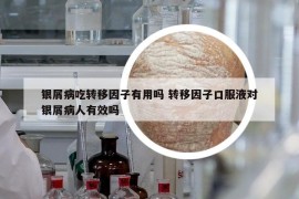 銀屑病吃轉(zhuǎn)移因子有用嗎 轉(zhuǎn)移因子口服液對(duì)銀屑病人有效嗎