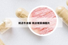斑點(diǎn)牛皮癬 斑點(diǎn)銀屑病圖片