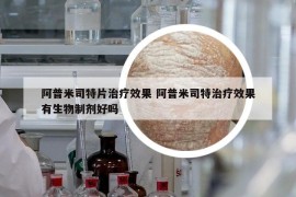 阿普米司特片治療效果 阿普米司特治療效果有生物制劑好嗎