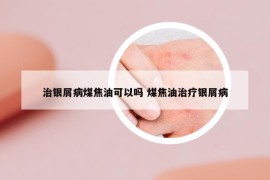 治銀屑病煤焦油可以嗎 煤焦油治療銀屑病