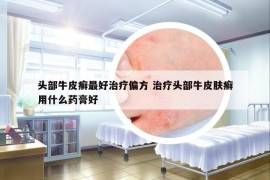 頭部牛皮癬最好治療偏方 治療頭部牛皮膚癬用什么藥膏好