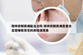 斑塊狀銀屑病能治念嗎 斑塊狀銀屑病患者會(huì)出現(xiàn)哪些常見的表現(xiàn)或現(xiàn)象