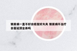 銀屑病一直不好會癌變好大夫 銀屑病不治療會蔓延到全身嗎