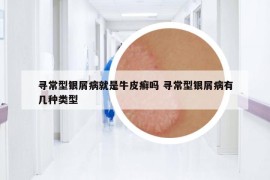 尋常型銀屑病就是牛皮癬嗎 尋常型銀屑病有幾種類型