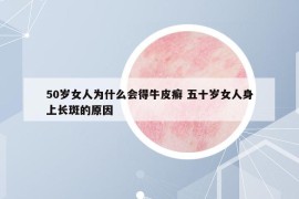 50歲女人為什么會(huì)得牛皮癬 五十歲女人身上長(zhǎng)斑的原因