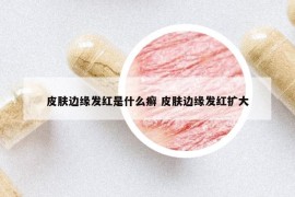 皮膚邊緣發(fā)紅是什么癬 皮膚邊緣發(fā)紅擴(kuò)大