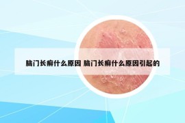 腦門長癬什么原因 腦門長癬什么原因引起的