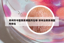 鄭州市中醫(yī)銀屑病醫(yī)院在哪 鄭州治銀屑病醫(yī)院排名