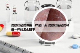 皮膚紅起皮像癬一樣是什么 皮膚紅色起皮和癬一樣的怎么回事