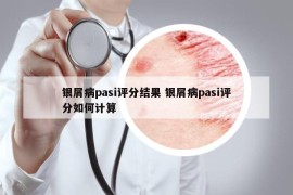 銀屑病pasi評分結(jié)果 銀屑病pasi評分如何計算