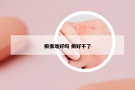 癬很難好嗎 癬好不了