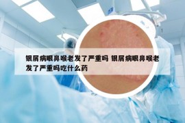 銀屑病眼鼻喉老發(fā)了嚴(yán)重嗎 銀屑病眼鼻喉老發(fā)了嚴(yán)重嗎吃什么藥