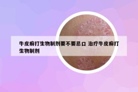 牛皮癬打生物制劑要不要忌口 治療牛皮癬打生物制劑