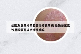 鹽酸左氧氟沙星膠囊治療銀屑病 鹽酸左氧氟沙星膠囊可以治療性病嗎