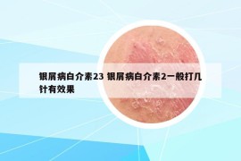 銀屑病白介素23 銀屑病白介素2一般打幾針有效果