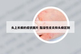 頭上長(zhǎng)癬的癥狀圖片 脂溢性皮炎和頭癬區(qū)別