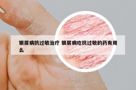 銀屑病抗過(guò)敏治療 銀屑病吃抗過(guò)敏的藥有用么