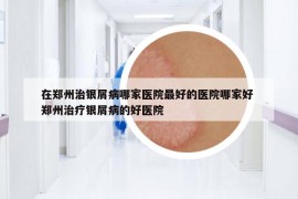 在鄭州治銀屑病哪家醫(yī)院最好的醫(yī)院哪家好 鄭州治療銀屑病的好醫(yī)院