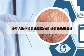綠豆方治療銀屑病是真的嗎 綠豆湯治銀屑病
