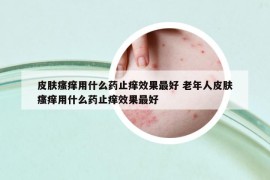 皮膚瘙癢用什么藥止癢效果最好 老年人皮膚瘙癢用什么藥止癢效果最好