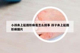 小孩身上起圓形癬是怎么回事 孩子身上起圓形癬圖片