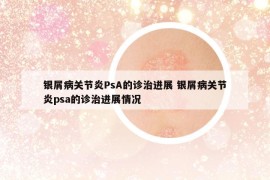 銀屑病關(guān)節(jié)炎PsA的診治進(jìn)展 銀屑病關(guān)節(jié)炎psa的診治進(jìn)展情況