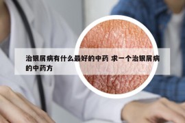 治銀屑病有什么最好的中藥 求一個(gè)治銀屑病的中藥方